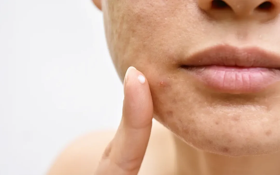 Acne Scarring After Adult Acne: Why It Behaves Differently to Teenage Scars