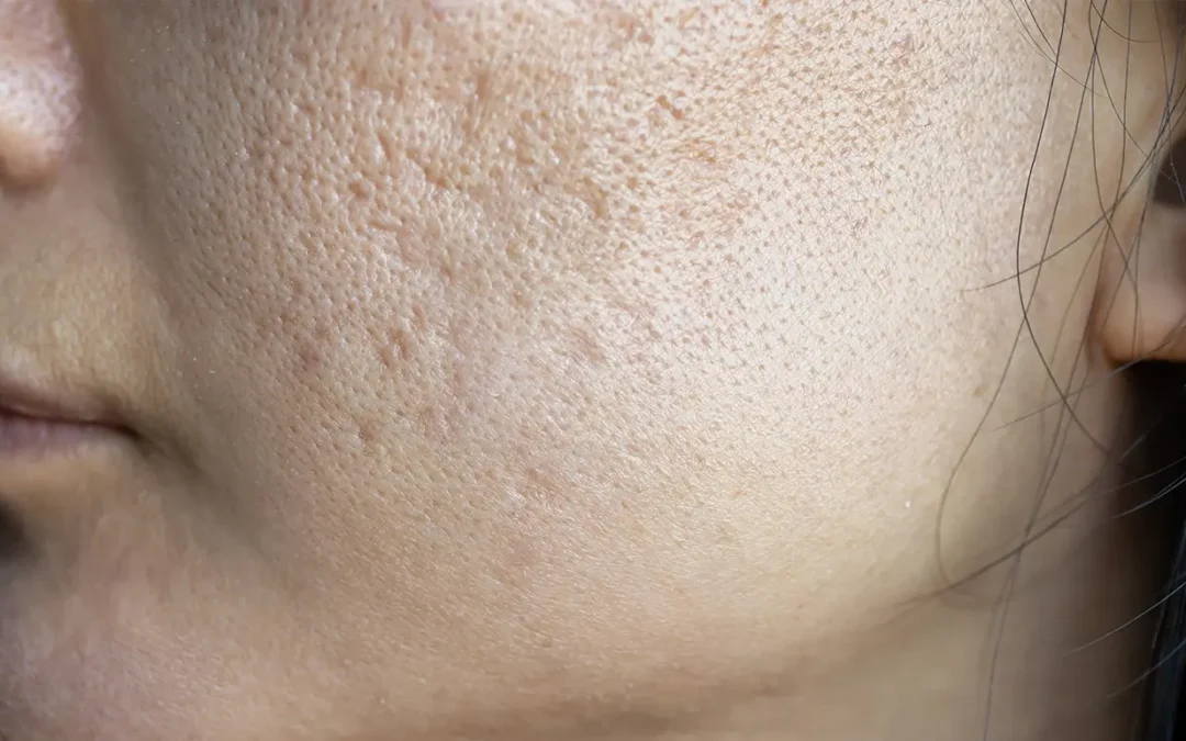 The Truth About Large Pores: What Really Works (and What Doesn’t)