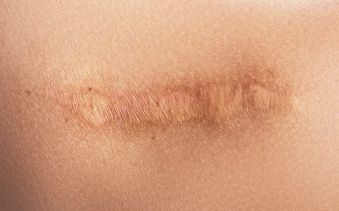 Subcision for Deep Scars: What It Is, Who It Helps & Why It Matters