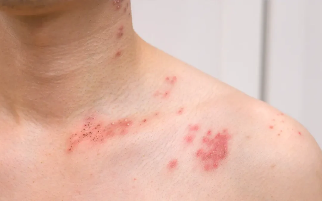 How Stress Hormones Affect the Skin (and Trigger Flare-Ups)