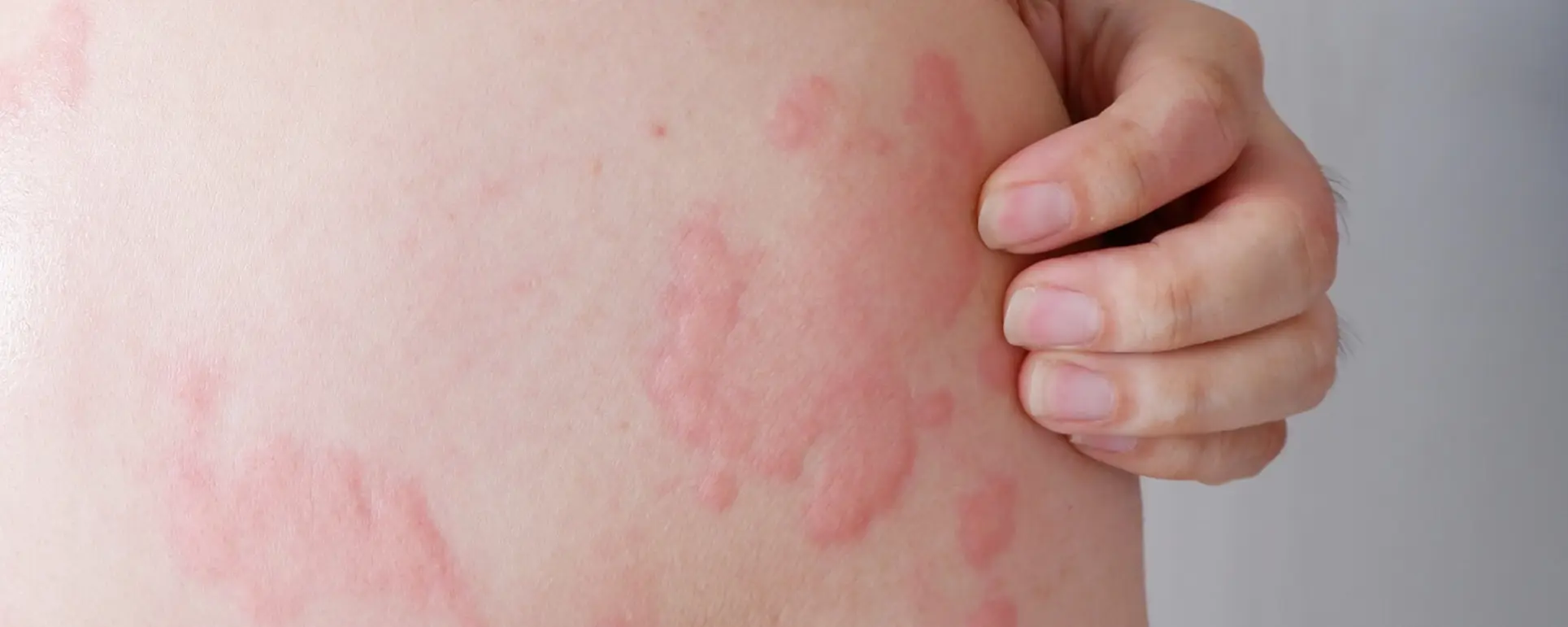 Hives 1