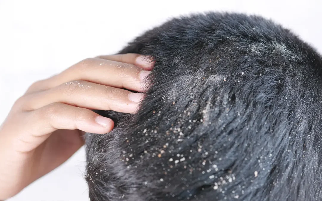 Alopecia and Dandruff: Are They Connected?