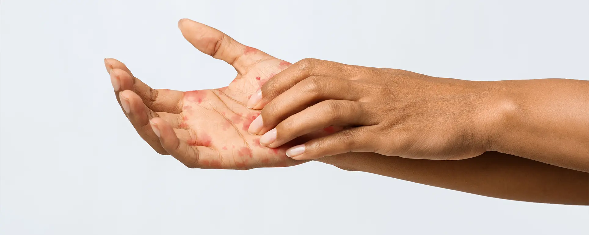 Itchy hands 1