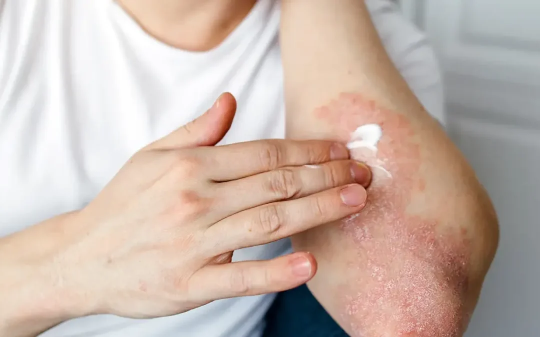 When Is Systemic Treatment Needed for Psoriasis? Dermatologist Criteria Explained