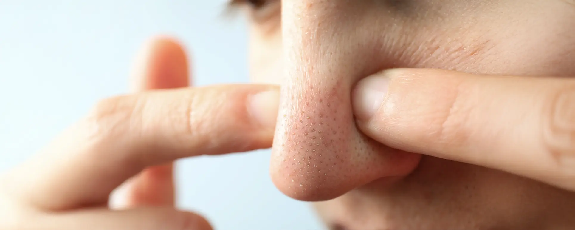Sebaceous Filaments Blackheads 01