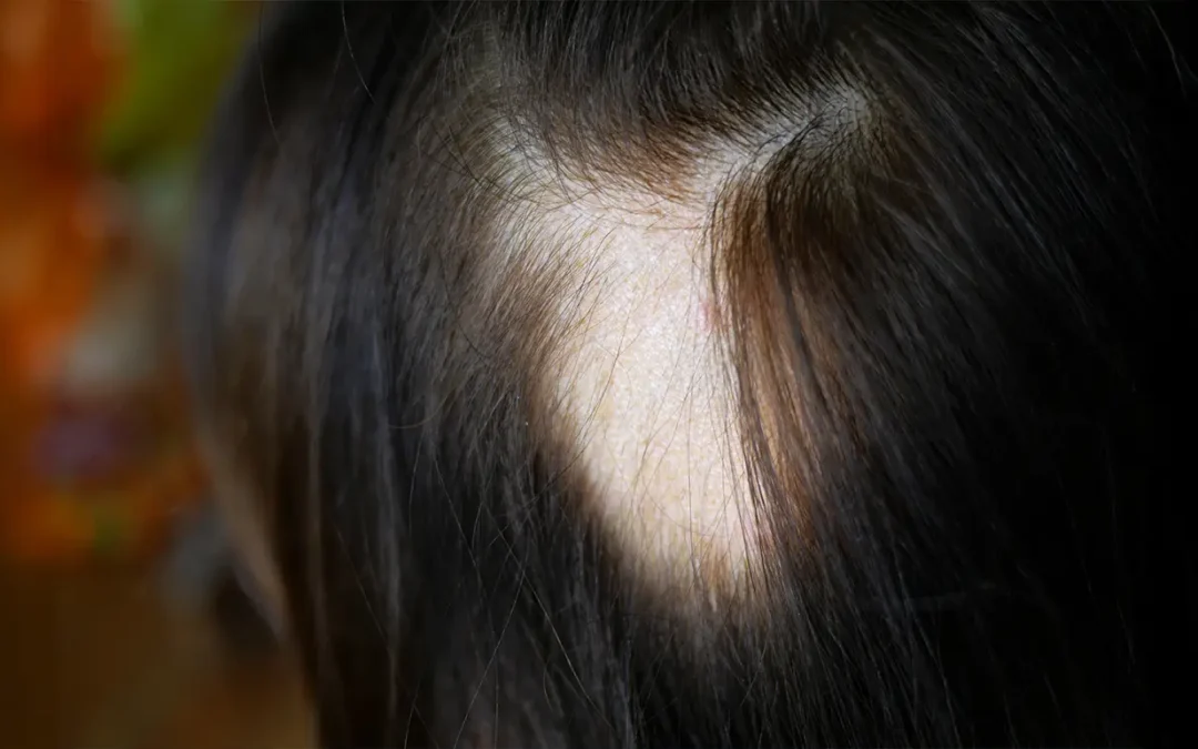 Patchy Alopecia Areata in Children: What Parents Should Know