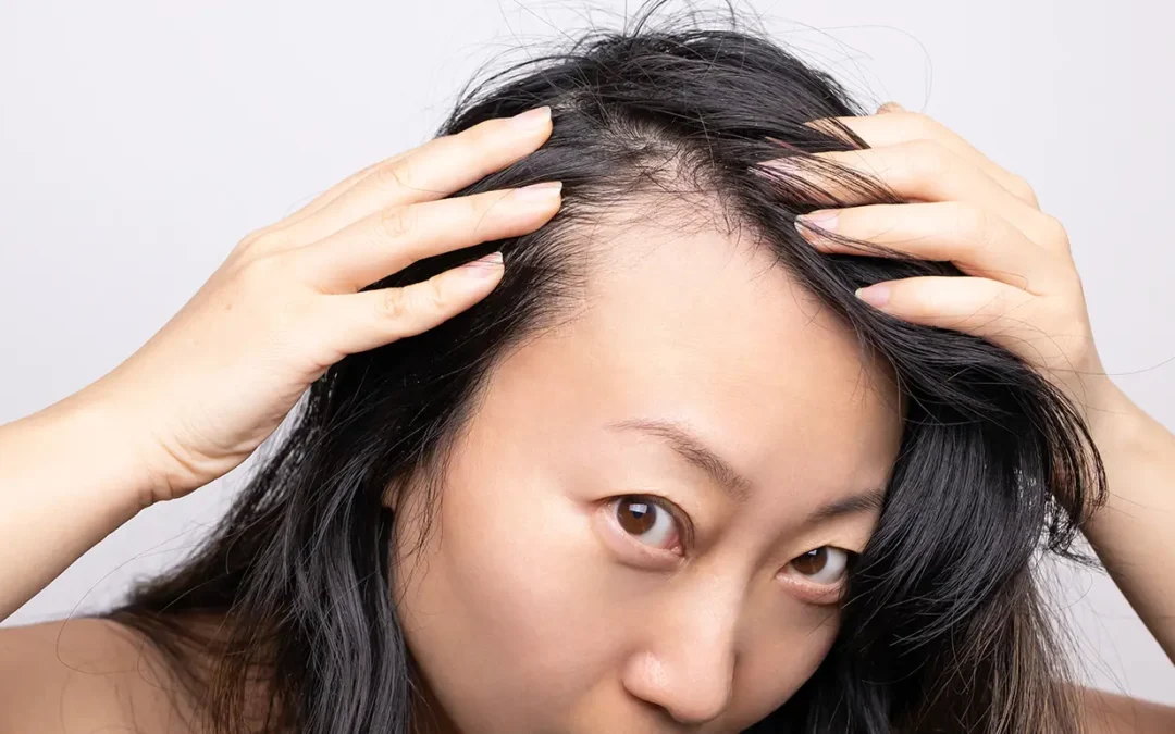 Post-Pregnancy Alopecia: How Long Does It Last?
