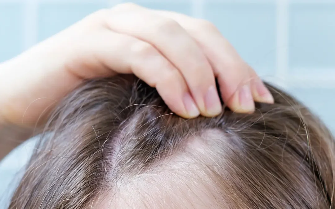 Alopecia After COVID or Viral Illness: What’s Temporary and What’s Not