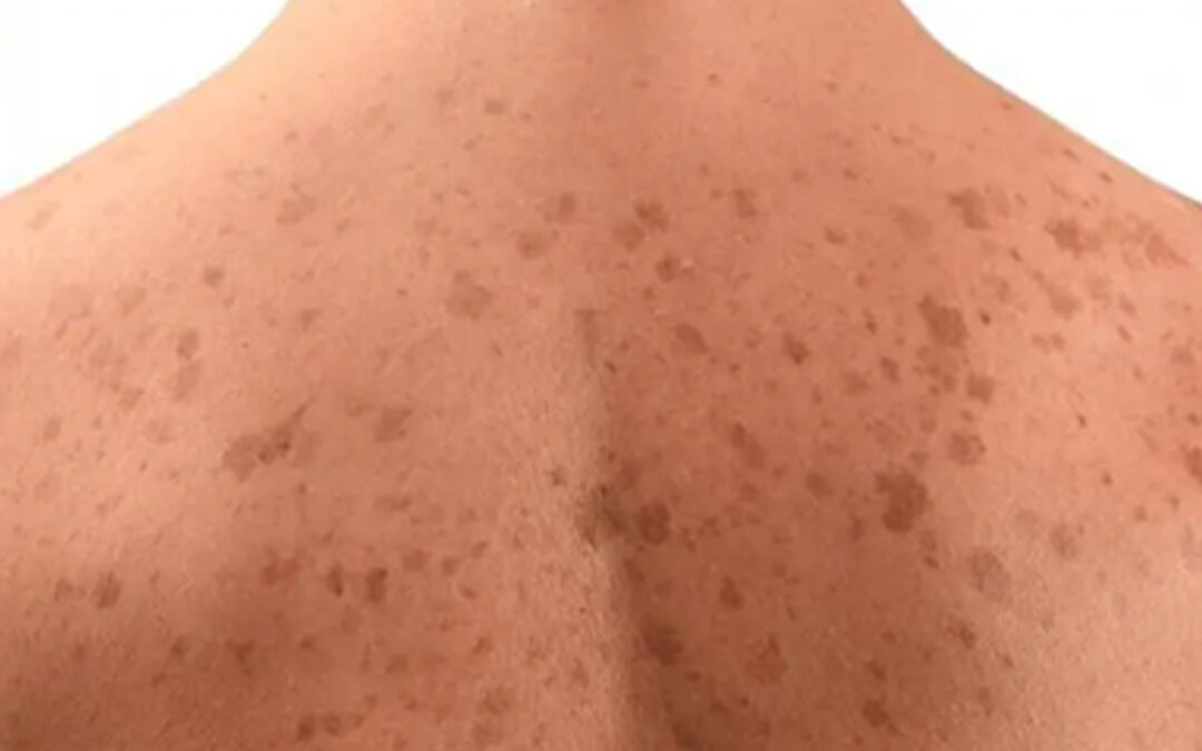 Dark Spots & Uneven Tone: Why Some Treatments Fail and What to Ask Your Dermatologist