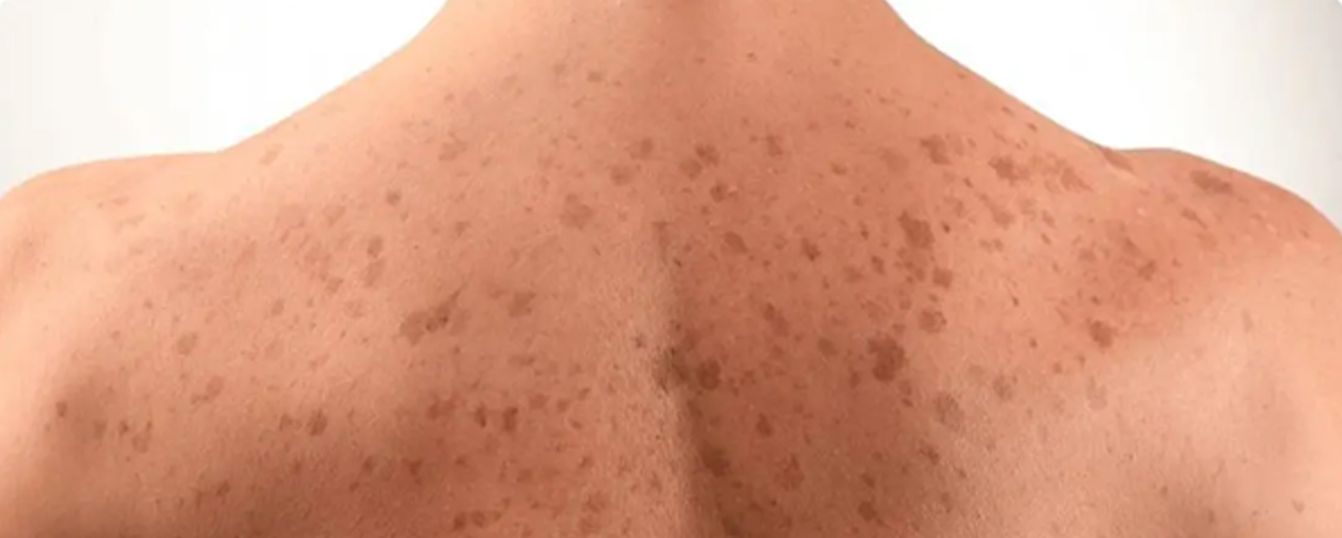 dark-spots Dark Spots