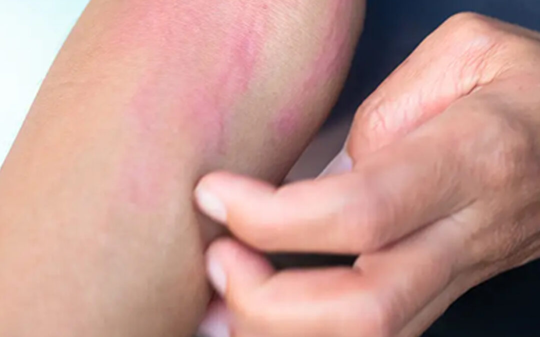 Sensitive Skin: When It’s More Than Just Dry What to Do & When to See a Dermatologist