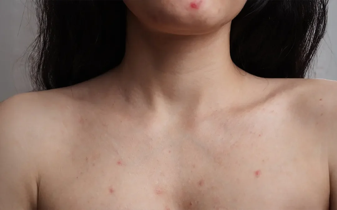 Acne Scarring on the Back & Chest: Why It Happens and Best Treatment Options