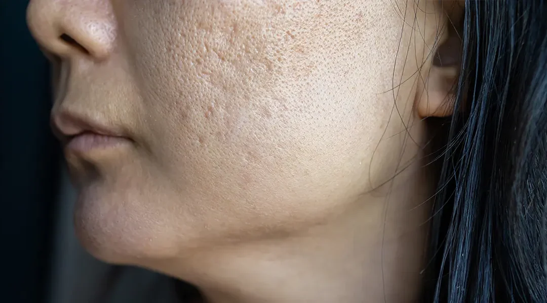 Laser Acne Scar Treatment for Darker Skin Tones: What’s Safe and What to Avoid