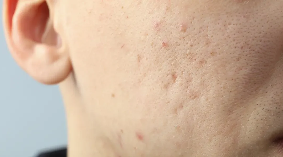 Why Laser Alone Often Fails for Acne Scars (and When Combination Treatment Is Needed)
