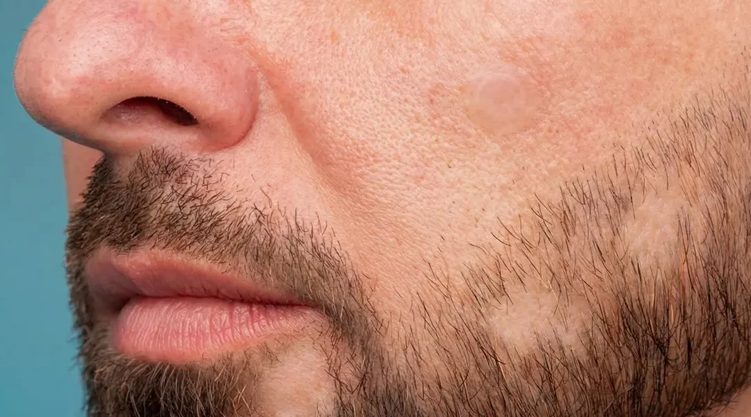 Alopecia of the Beard: Causes, Treatment Options and Prognosis