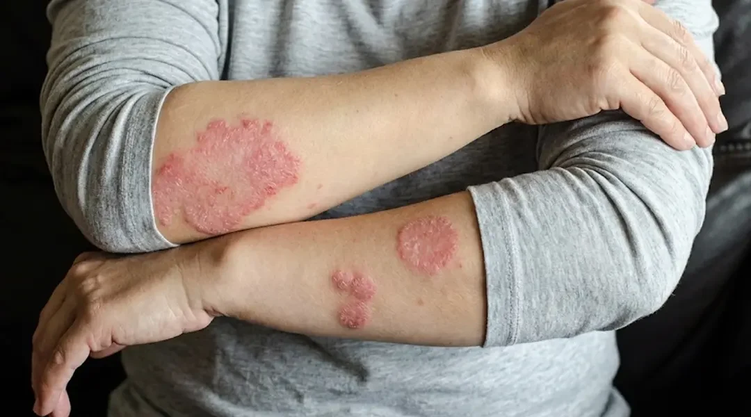 Discoid (Nummular) Eczema: Why Coin-Shaped Patches Keep Returning and How to Treat Them