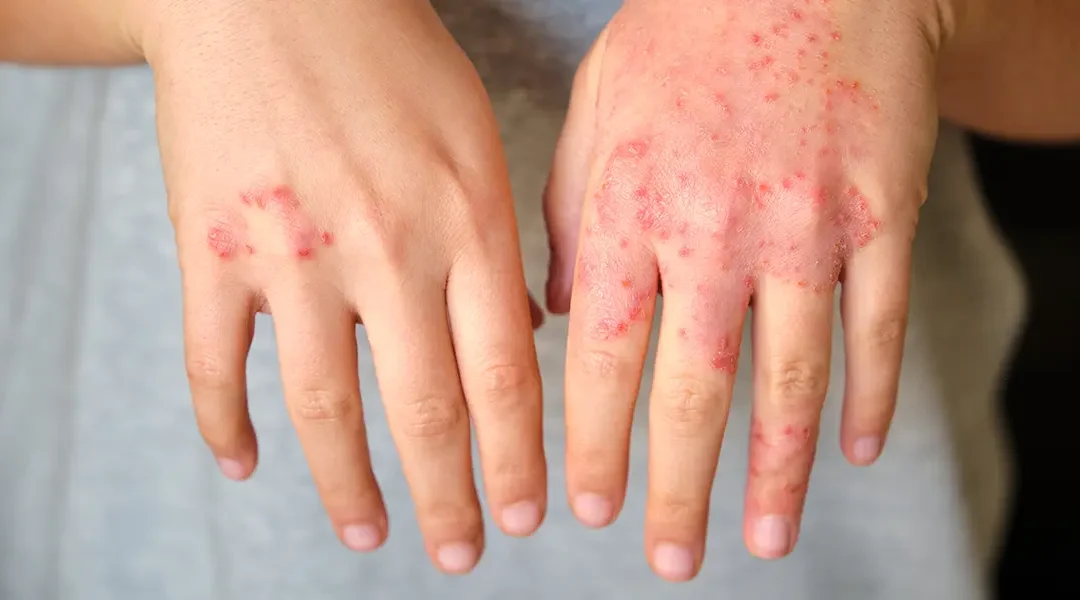 Pompholyx Eczema (Dyshidrotic Eczema): Blisters on Hands and Feet Best Treatments