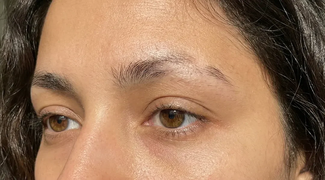 Alopecia of the Eyebrows and Lashes: Why It Happens and How It’s Treated