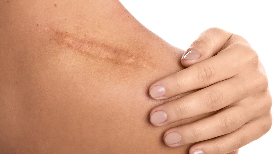 PRP & Stem-Cell Based Scar Treatments: Are They Worth?