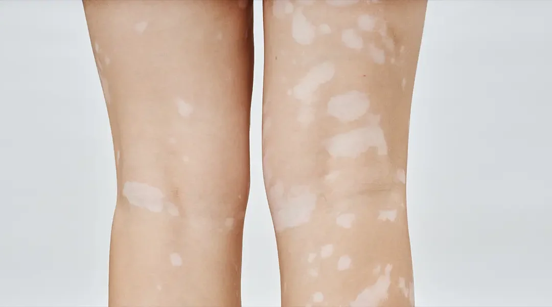 Can Vitiligo Spread Suddenly? Understanding Fast vs Slow Progression