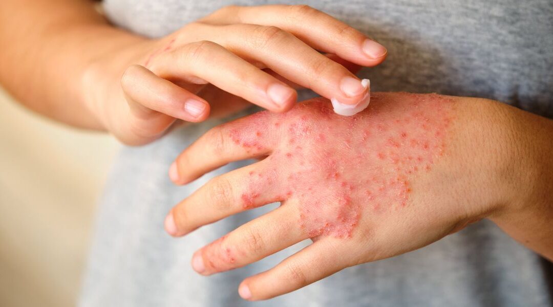 Skin Microbiome Dysbiosis in Eczema: Cause, Consequence, or Both?
