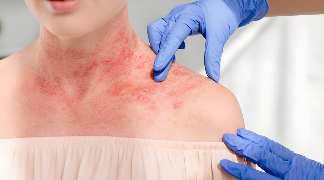 Th2-Dominant Inflammation in Eczema: Beyond Surface Redness