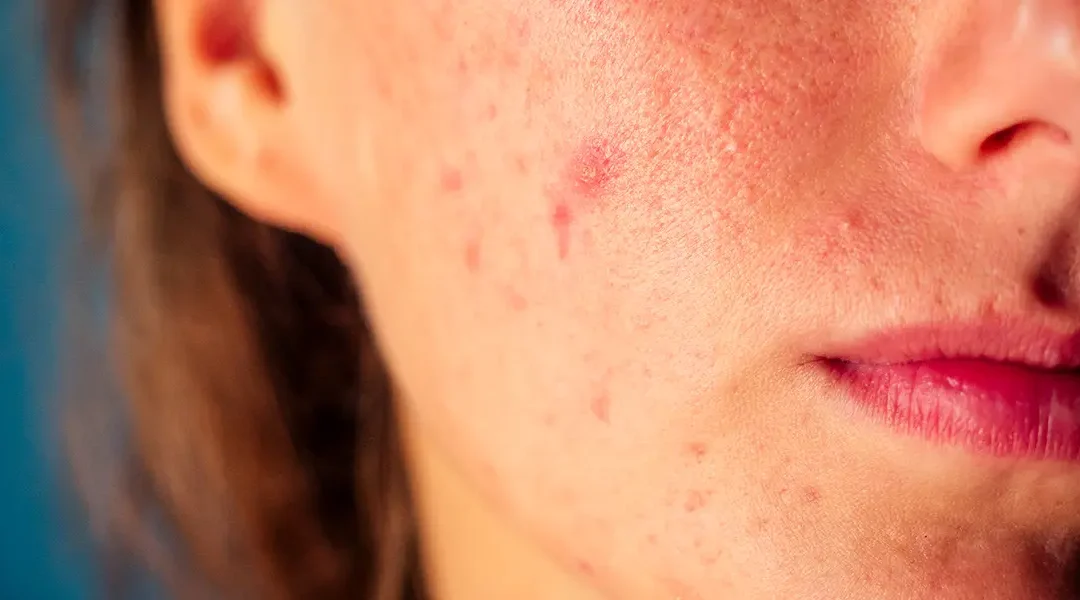 How Many Laser Sessions Are Needed for Acne Scars? Realistic Expectations Explained