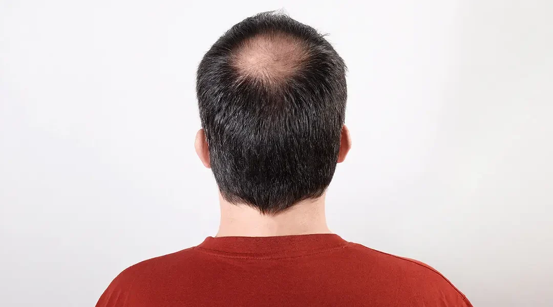 Alopecia Prognosis: How Dermatologists Predict Regrowth and Long-Term Outcomes
