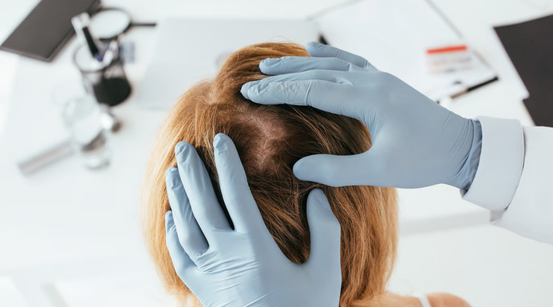 Hair Follicle Immune Privilege and Alopecia Areata: What Goes Wrong?