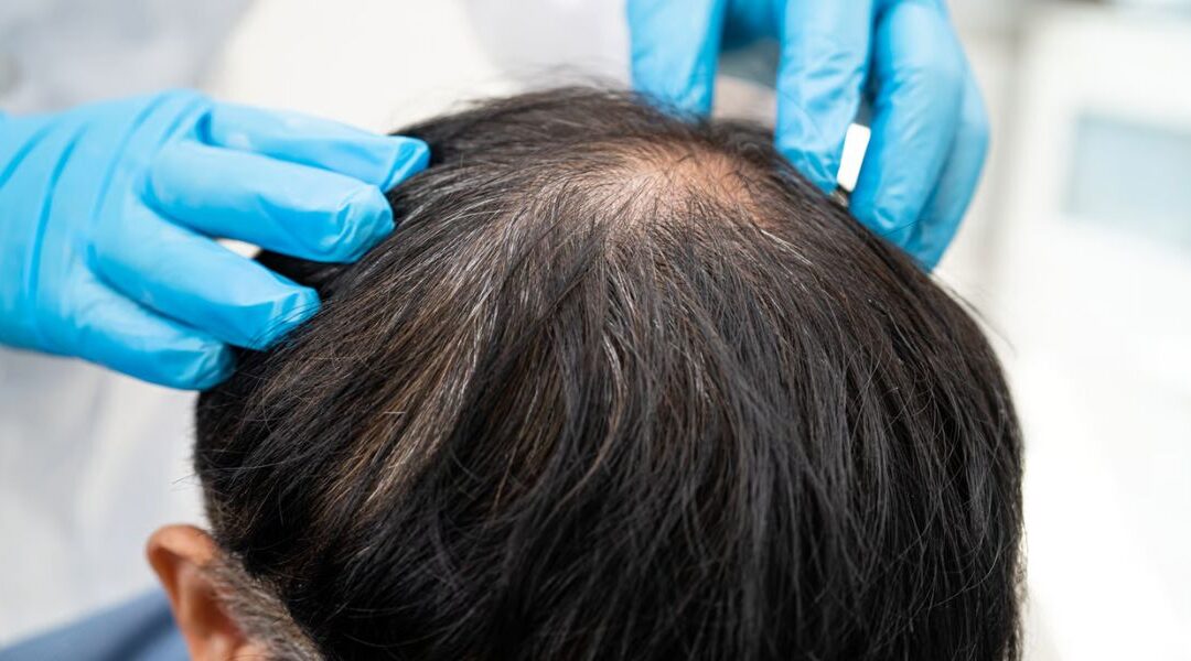 JAK–STAT Pathway Dysregulation in Alopecia: Beyond Treatment Headlines