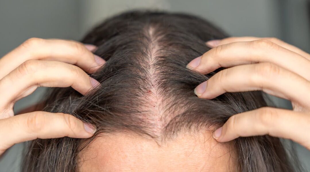 Hair Follicle Stem Cell Dysfunction in Alopecia: What the Research Shows