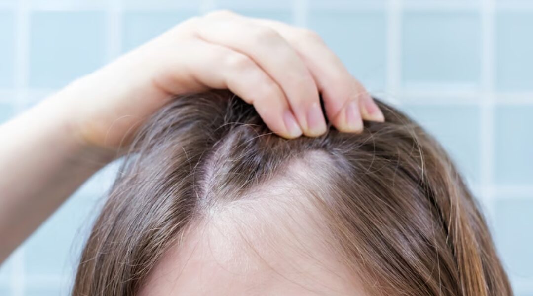 Female Pattern Hair Loss: Causes, Diagnosis and Modern Treatment Options 