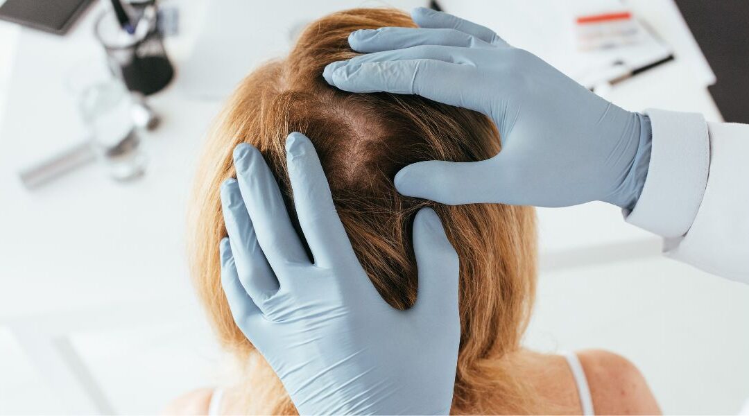 Alopecia Areata: Early Signs and Why Fast Treatment Matters