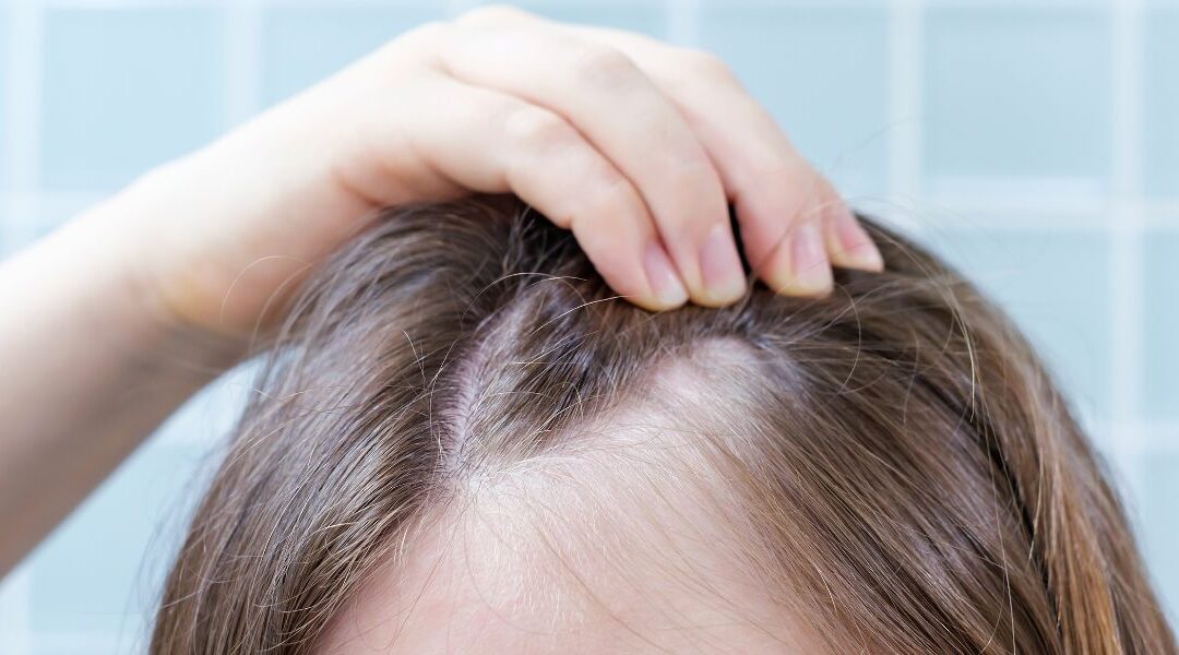 Frontal Fibrosing Alopecia: Why Is It Increasing in Women?