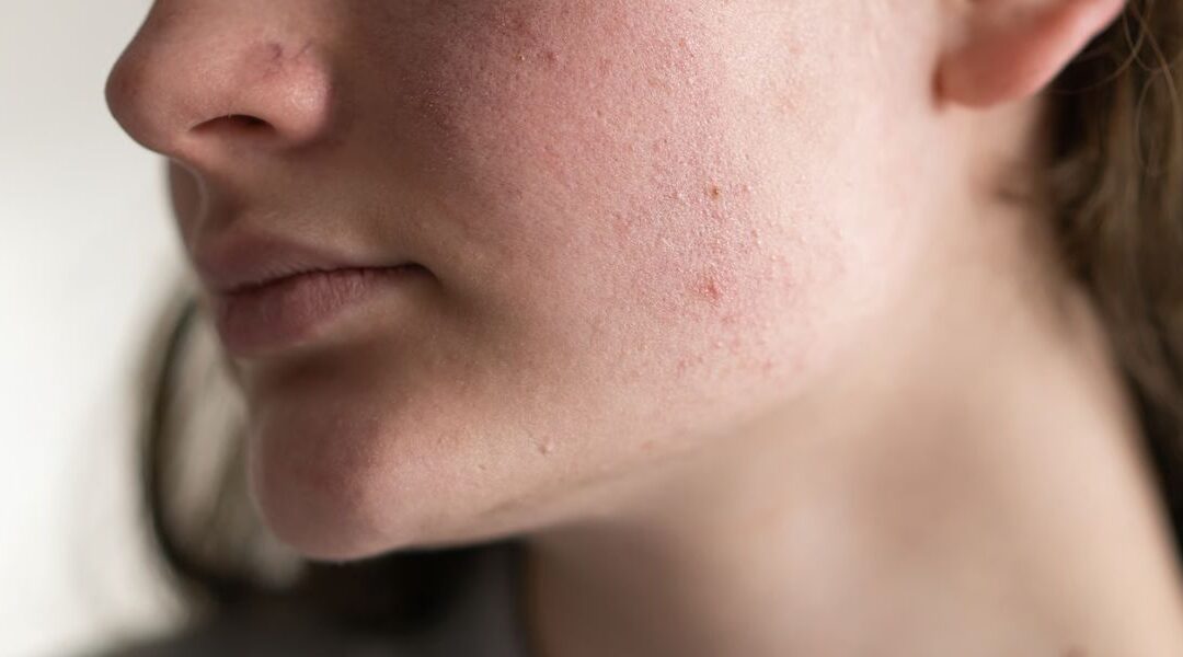 Why Has My Skin Suddenly Become Sensitive?