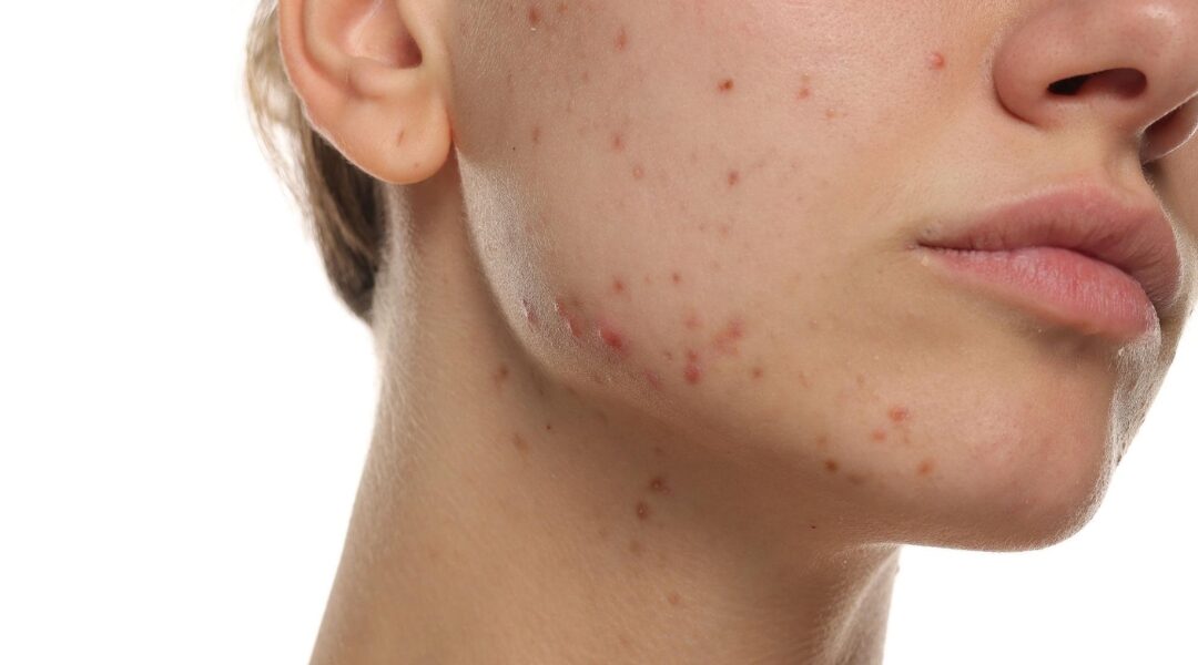 PCOS and Your Skin: Acne, Pigmentation and Excess Hair Explained 
