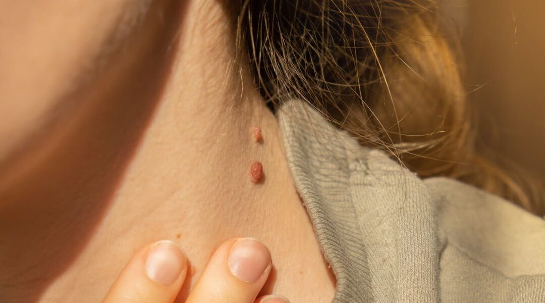 Skin Tags: What Causes Them and Should You Remove Them? 