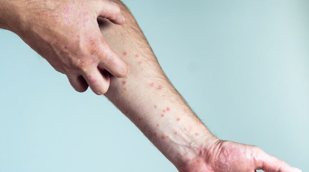 Epigenetics and Skin Disease: How Environment Alters Gene Expression