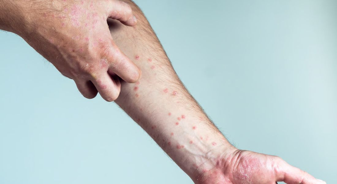 Epigenetics and Skin Disease_ How Environment Alters Gene Expression