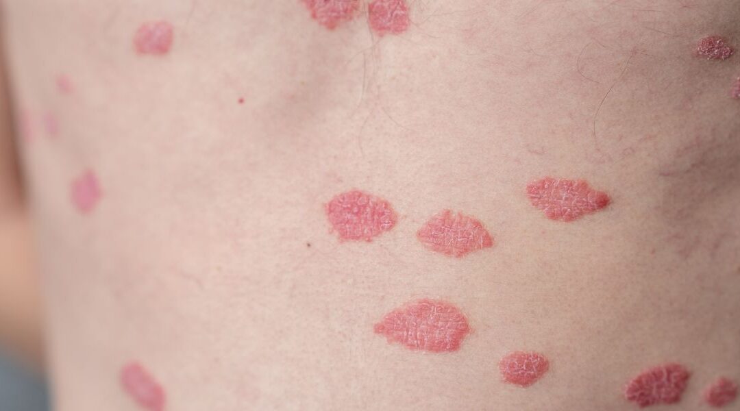 Biologic Therapy for Psoriasis: How Dermatologists Decide Who Benefits Most