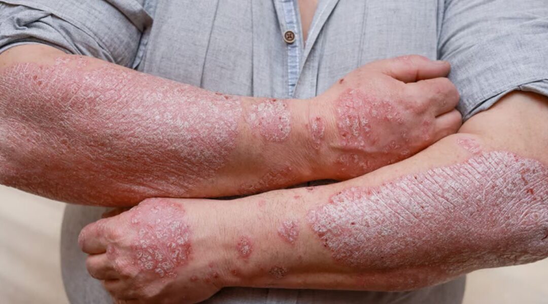 Why Psoriasis Treatments Sometimes Stop Working (And What Comes Next)