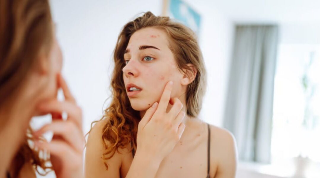 Skin Changes During the Menstrual Cycle: Dermatological Insights