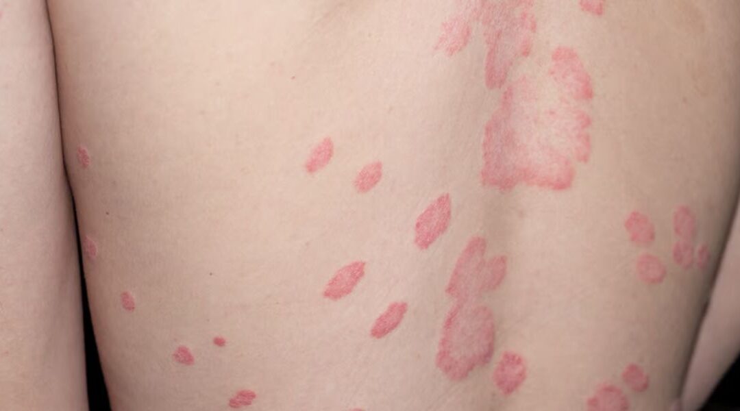 Psoriasis and Systemic Inflammation: What It Means Beyond the Skin