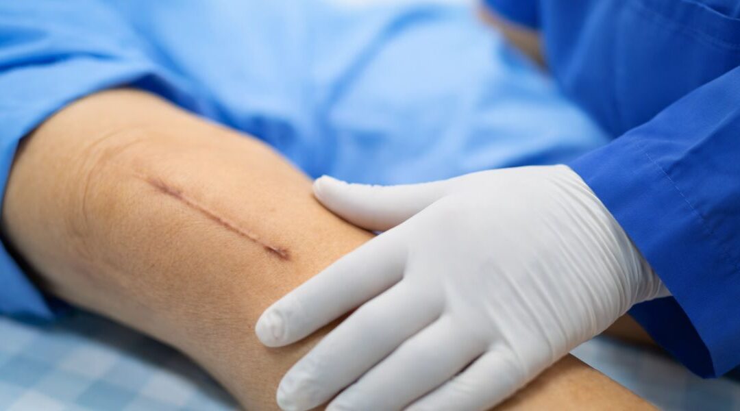 The Future of Scar Treatment: Combining Energy Devices and Biologic Modulation 