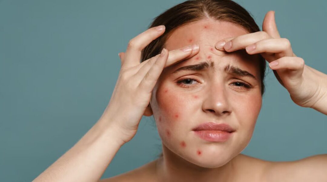 The Link Between Chronic Skin Conditions and Anxiety