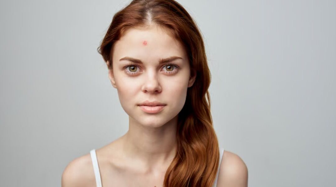Why Your Skin Flares Up at the Worst Possible Times