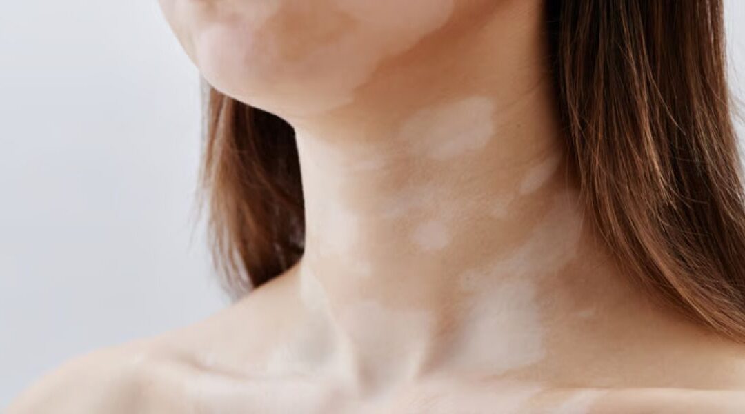 Segmental Vitiligo: How It Differs From Other Types
