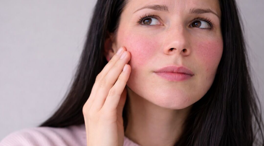 Late-Onset Rosacea: Why It Develops in Adulthood