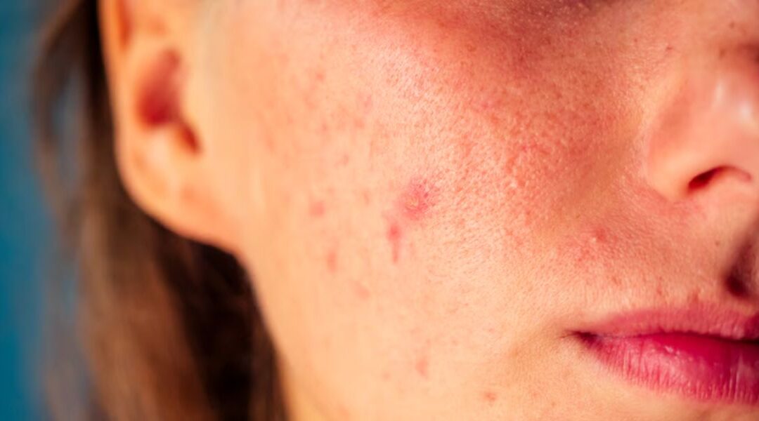 Rosacea Misdiagnosis: Conditions Commonly Mistaken for Rosacea