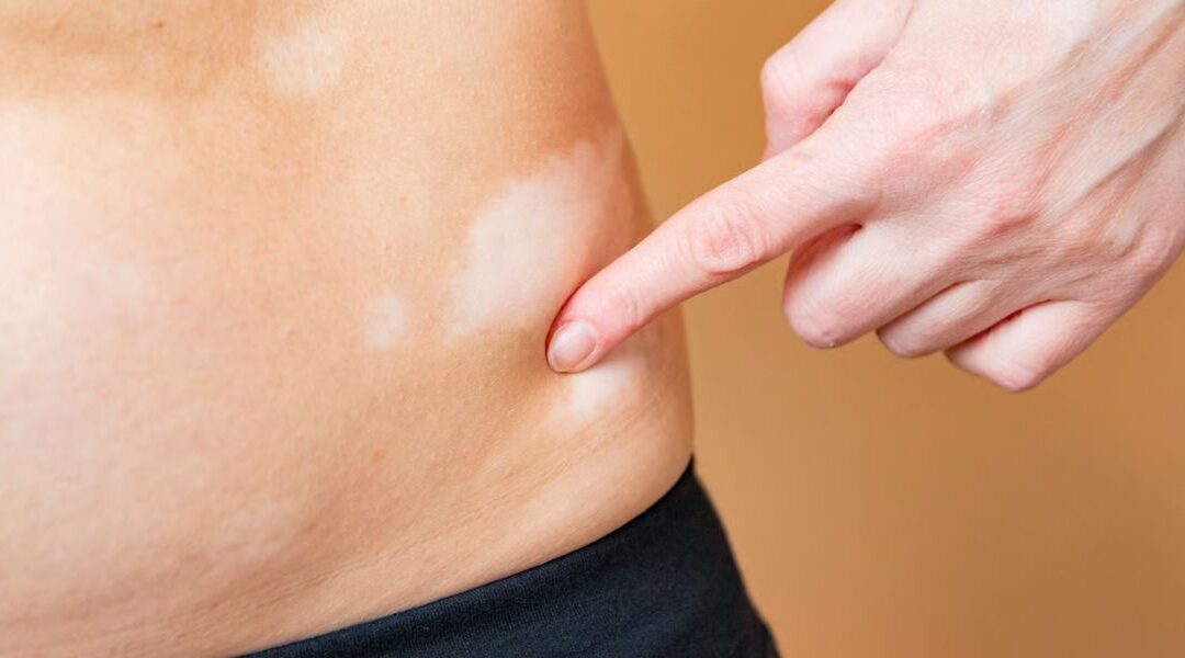 Vitiligo Stability: How Dermatologists Determine If It Is Active or Stable